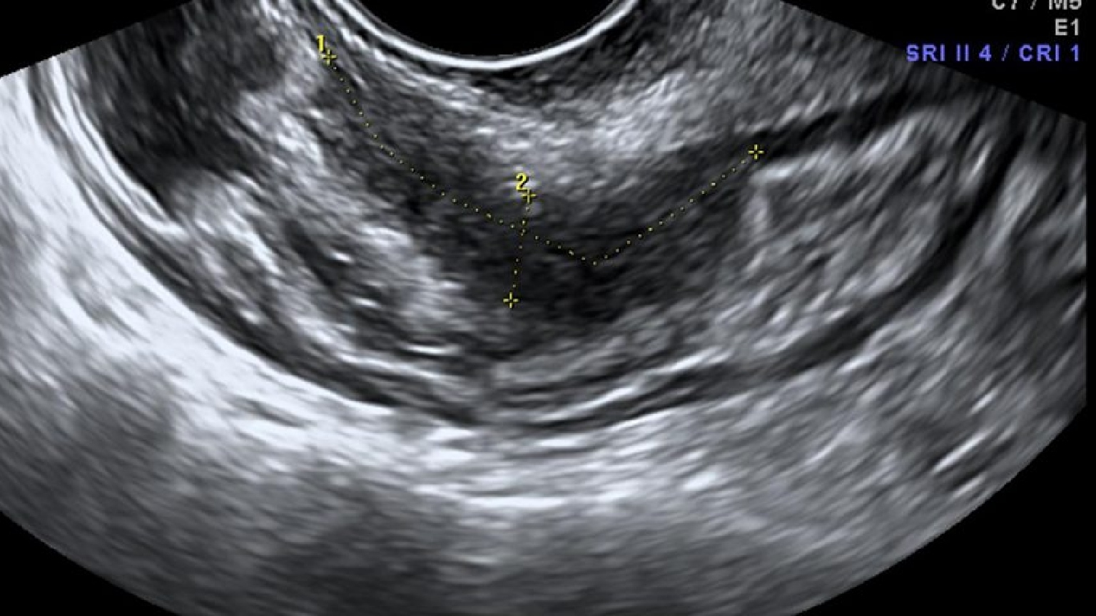 Endometriosis con ecografía transvaginal